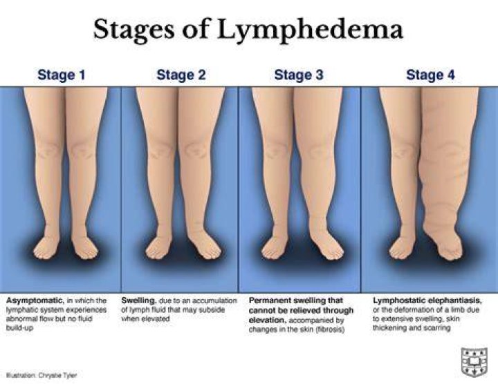 Ask the Doctors Lymphedema Symptoms and Causes with Doctors Sacks and
