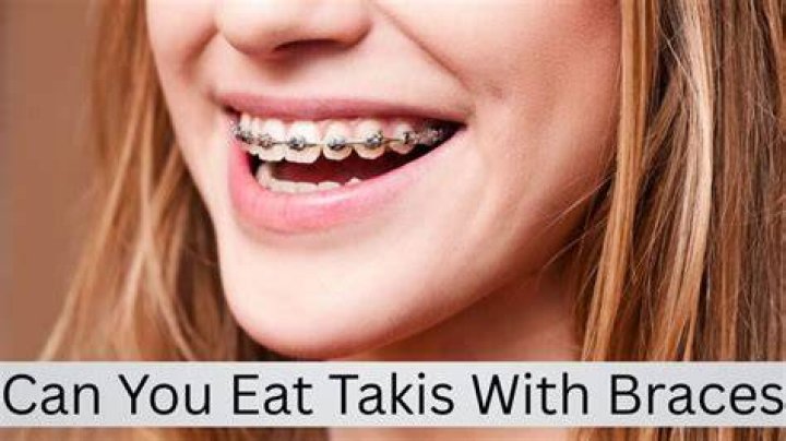 Can You Eat Takis With Braces? Expert Advice And Alternatives