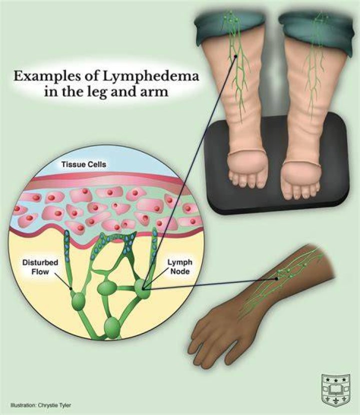 Does lymphedema need to be treated? Montreal Lymphedema Treatment