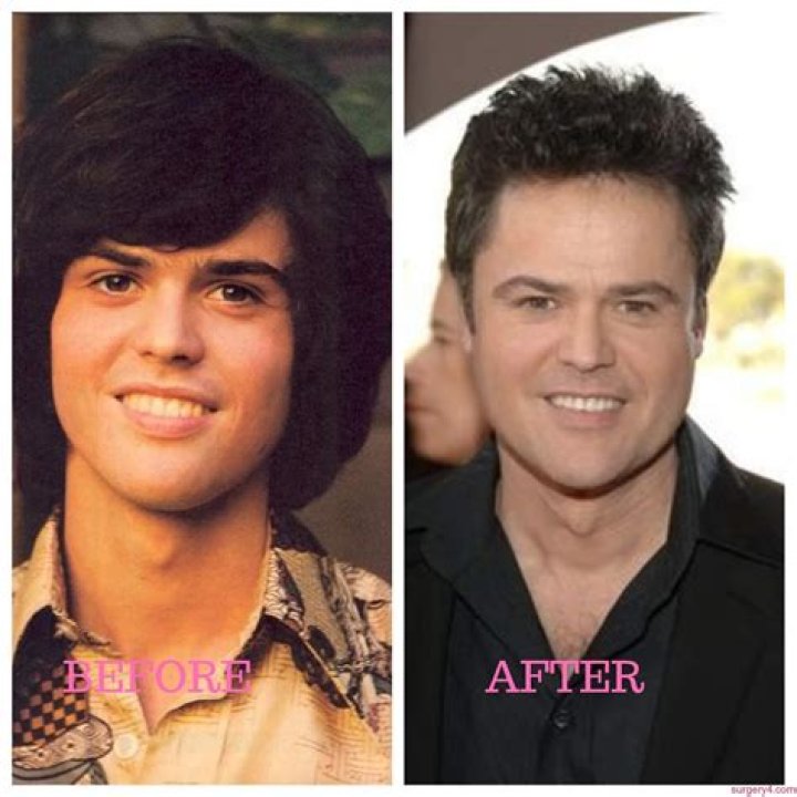 Donny Osmond Plastic Surgery Photos [Before & After] Surgery4