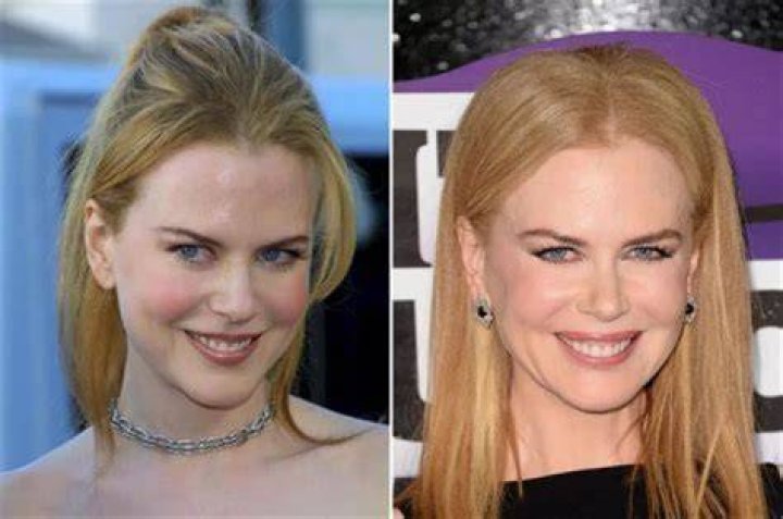 Explore Nicole Kidman's Journey With Anorexia
