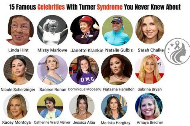 List of Celebrities With Turner Syndrome Public Health